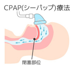 CPAP治療法画像_1